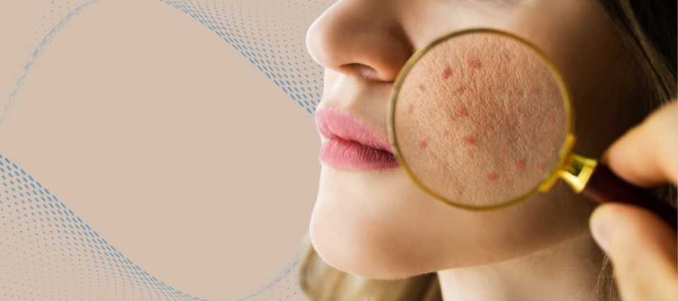 Acne Face Mapping and Personalized Skincare: The Role of AI in Customizing Treatments